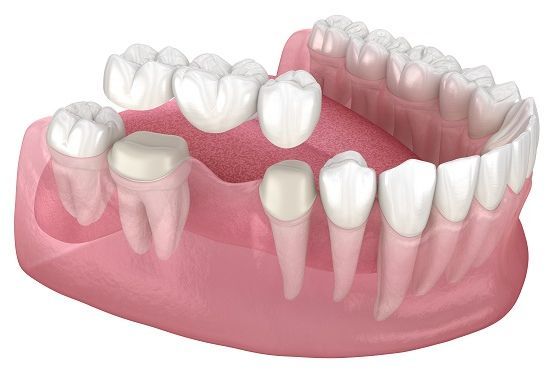 Unterkiefer, in den eine Zahnkrone eingesetzt wird