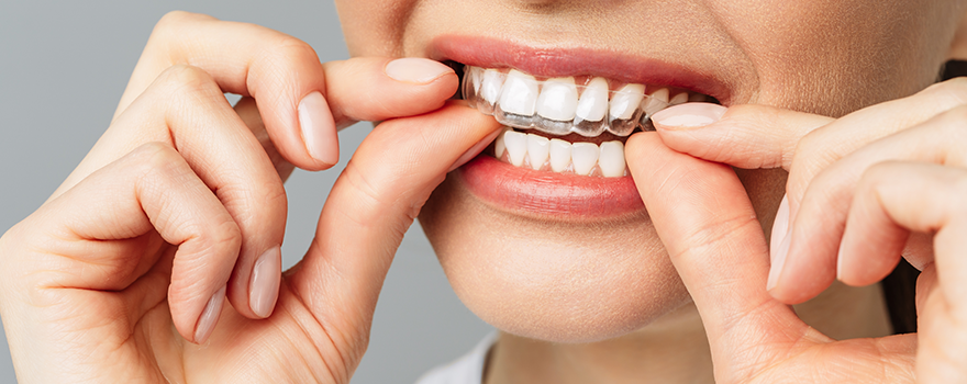 Frau gibt eine durchsichtige Zahnschiene auf ihre Zähne.